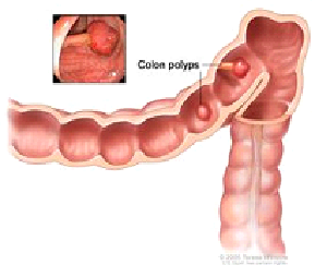 Polyps in the colon. Some polyps have a stalk and others do not. Inset shows a photo of a polyp with a stalk.