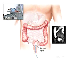 Barium enema procedure. The patient lies on an x-ray table. Barium liquid is put into the rectum and flows through the colon. X-rays are taken to look for abnormal areas.