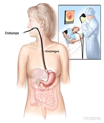 Esophagoscopy. A thin, lighted tube is inserted through the mouth and into the esophagus to look for abnormal areas.