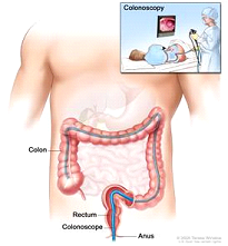 Colonoscopy. A thin, lighted tube is inserted through the anus and rectum and into the colon to look for abnormal areas.