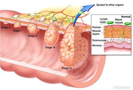 As colon cancer progresses from Stage 0 to Stage IV, the cancer cells grow through the layers of the colon wall and spread to lymph nodes and other organs.
