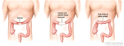 Colon cancer surgery with anastomosis. Part of the colon containing the cancer and nearby healthy tissue is removed, and then the cut ends of the colon are joined.